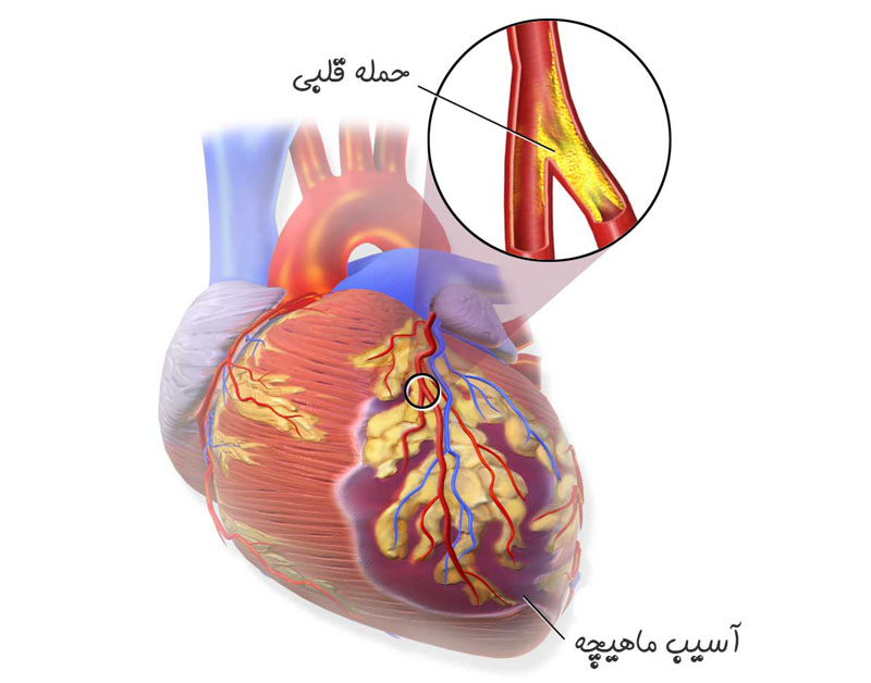 علائم حمله سکته قلبی، سکته قلبی چیست، علائم بروز سکته قلبی، چگونه می توان از سکته قلبی جلوگیری کرد