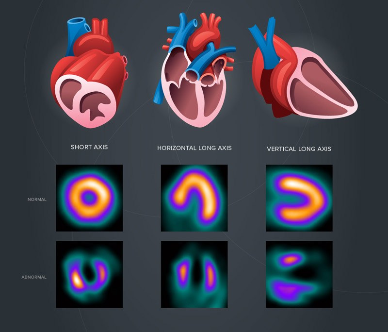 اسکن هسته ای قلب چیست اسکن هسته ای قلب اسکن هسته ای قلب چگونه انجام میشود اسکن هسته ای قلب مشهد تحلیل اسکن قلب عوارض اسکن هسته ای برای اطرافیان گاما اسکن چیست تحلیل اسکن قلب