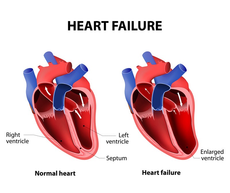سکته قلبی علائم سکته قلبی در جوانان علائم سکته قلبی خاموش حمله قلبی چگونه رخ میدهد جلوگیری از سکته قلبی فوری کمک های اولیه در سکته قلبی عوارض سکته قلبی رد كردن سكته قلبي هنگام سکته قلبی چه کنیم