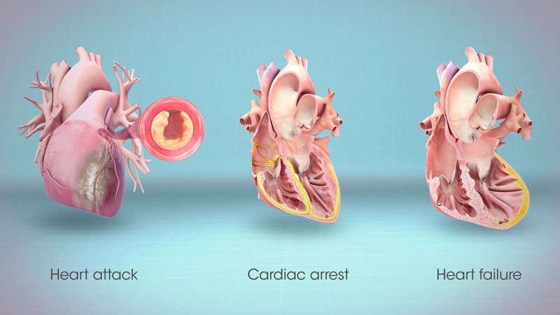 سکته قلبی علائم سکته قلبی در جوانان علائم سکته قلبی خاموش حمله قلبی چگونه رخ میدهد جلوگیری از سکته قلبی فوری کمک های اولیه در سکته قلبی عوارض سکته قلبی رد كردن سكته قلبي هنگام سکته قلبی چه کنیم