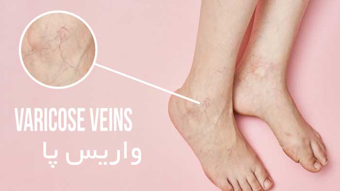 Varicose-veins-of-the-foot-ghalb-negar.jpg